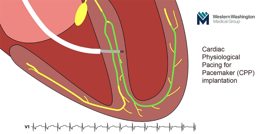 illustration of cpp Cardiac Physiological Pacing for Pacemaker device implantation in the heart western washington medical group image